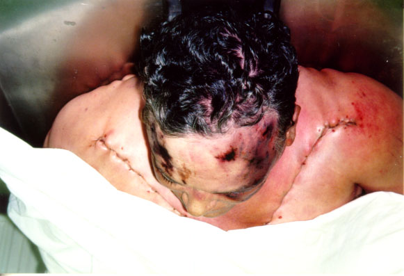 Louis Torres autopsy photos.